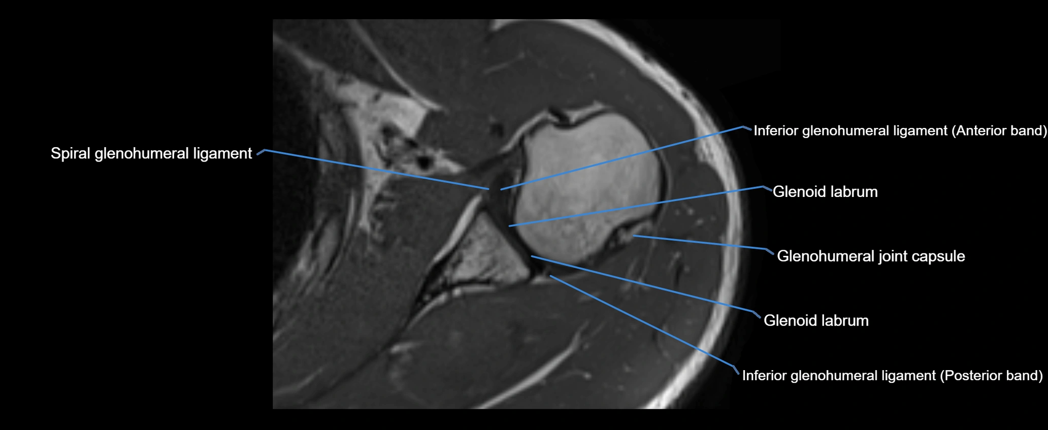 shoulder ligaments axial 3d 3t mri image-img-00005-00076.webp